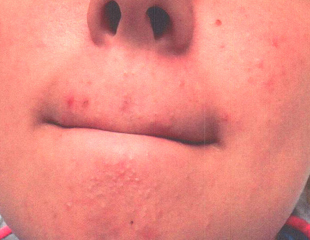 Acne-6